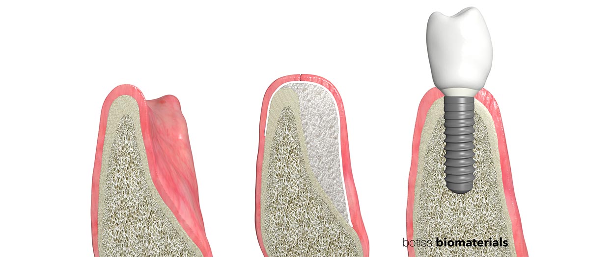 Guided Bone Regeneration (GBR) in Lahnstein: Knochenaufbau